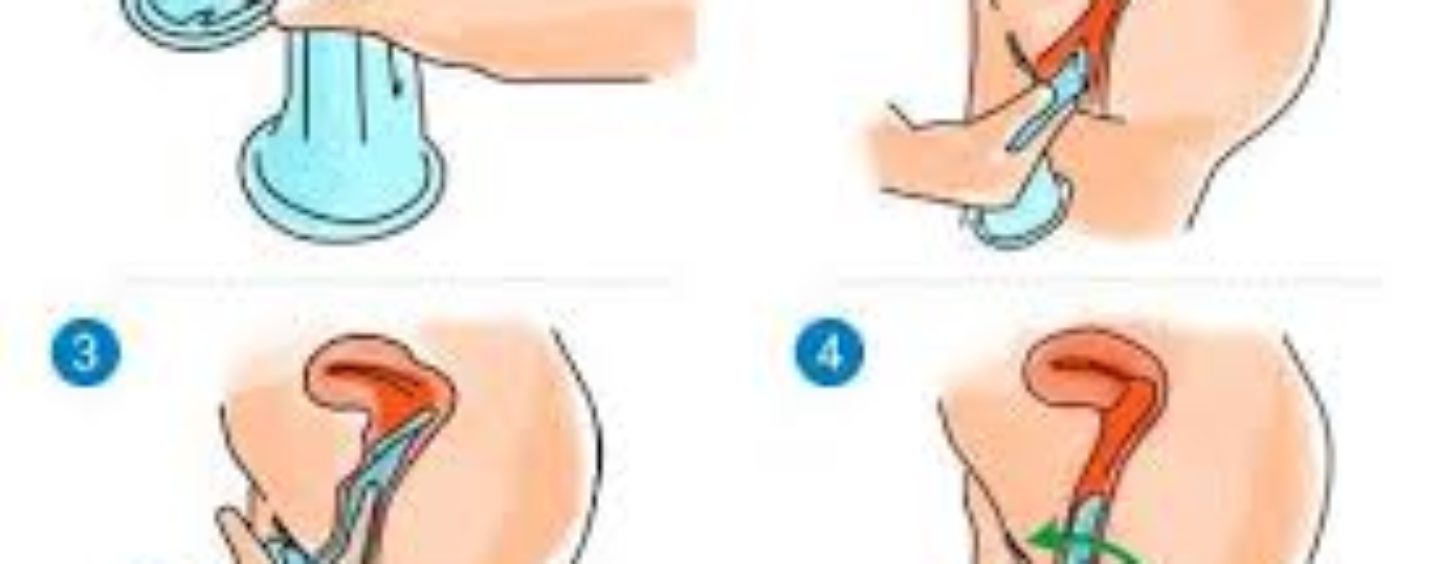 Preservativo vaginal o femenino
